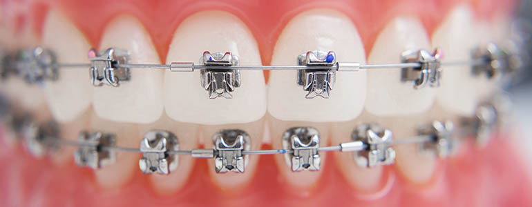 Ventajas de la ortodoncia en adultos