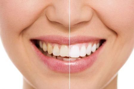 Clínica Dental Sevilla | Blanqueamiento dental