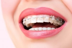 Clínica Dental Sevilla | Especialistas en ortodoncia estética
