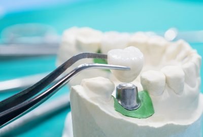 Clínica Dental Sevilla | Especialistas en implantes dentales