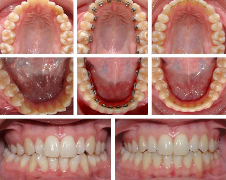 Clínica Dental Sevilla | Tratamiento ortodoncia lingual